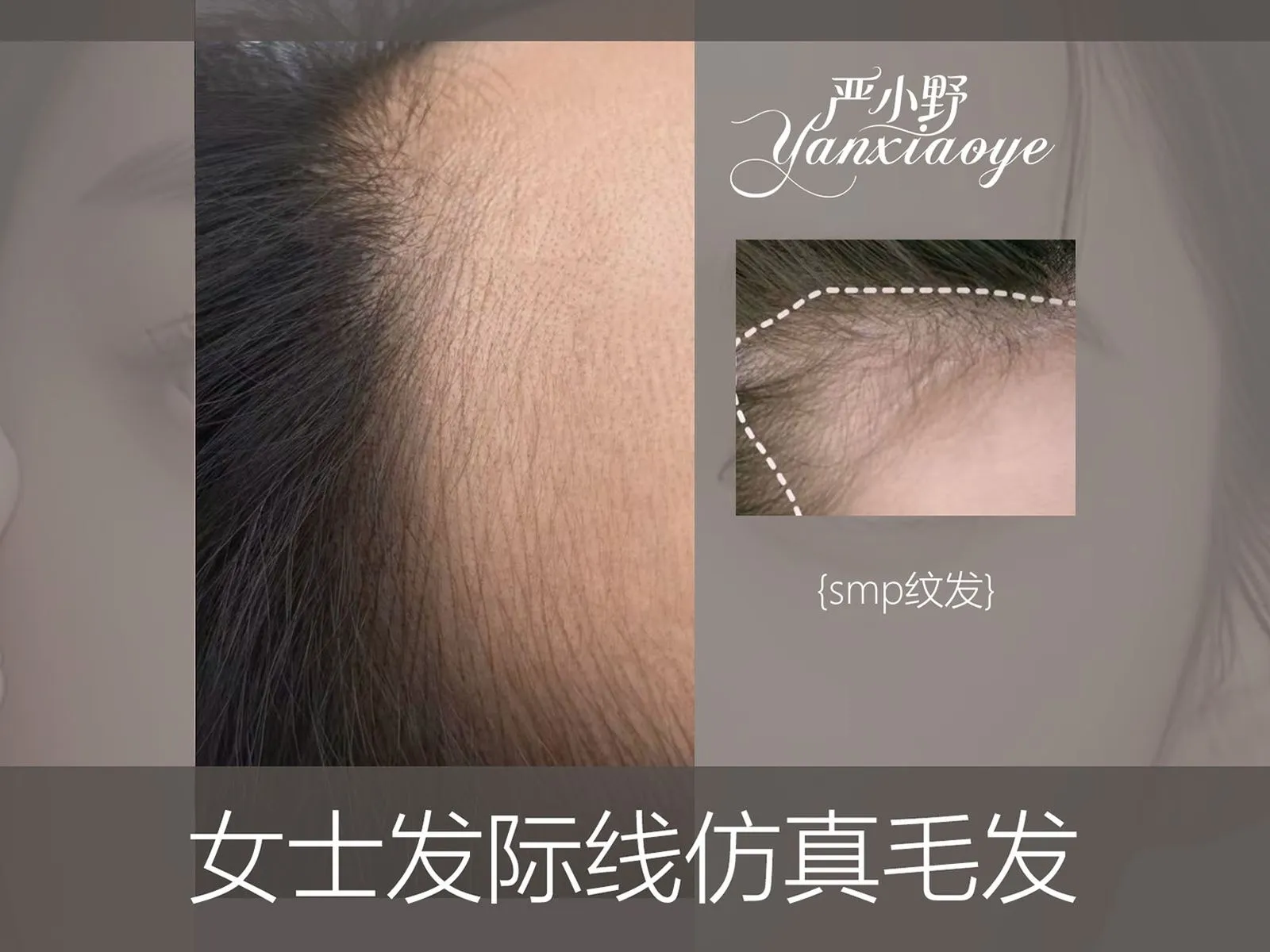 女士发际线仿真毛发