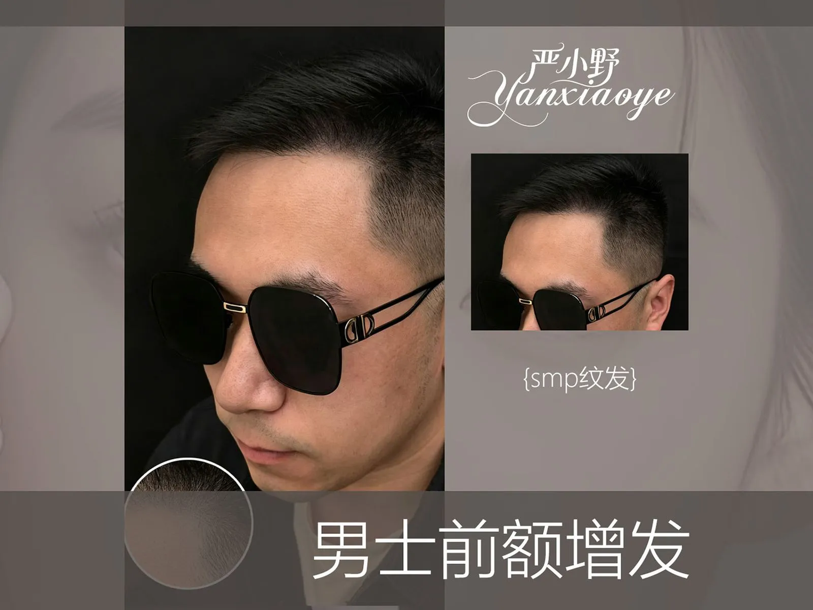 男士前额增发