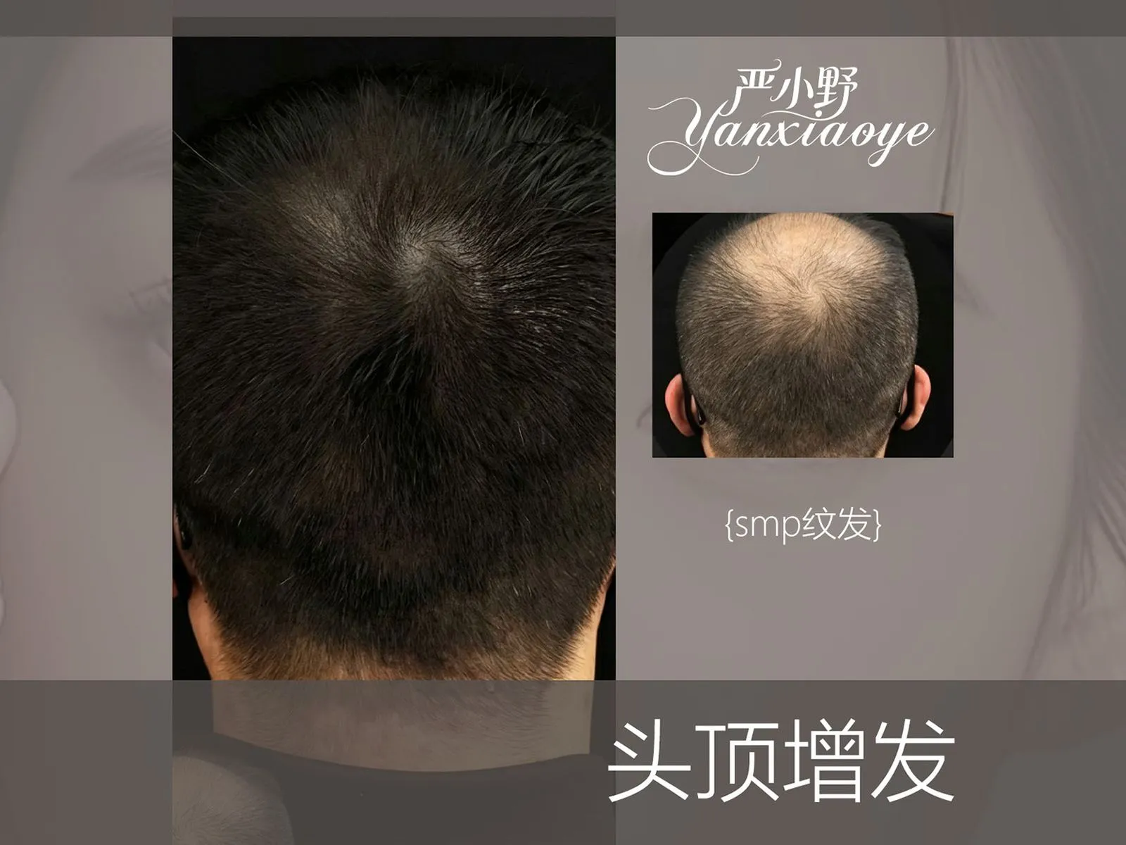 头顶增发